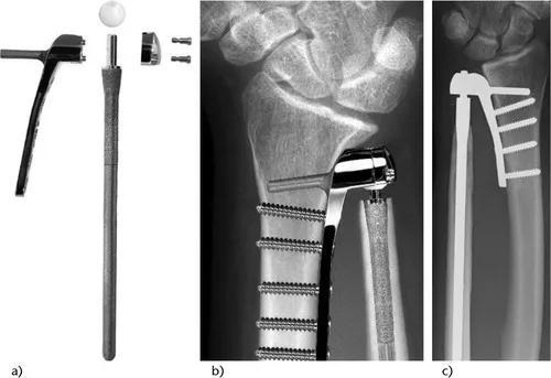 马德隆畸形最新治疗方法揭秘，小巷深处的神秘小店